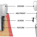 اجزاء ایمپلنت دندان