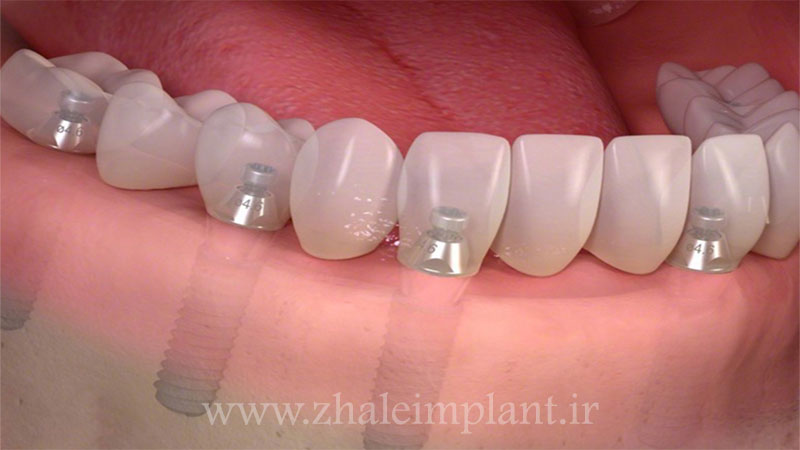 شرایط لازم جهت ایمپلنت دندان