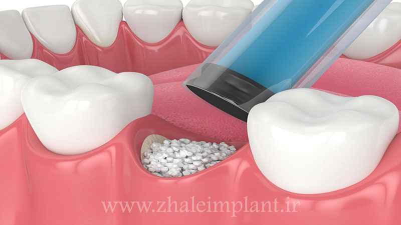آماده سازی استخوان از شرایط لازم جهت ایمپلنت دندان