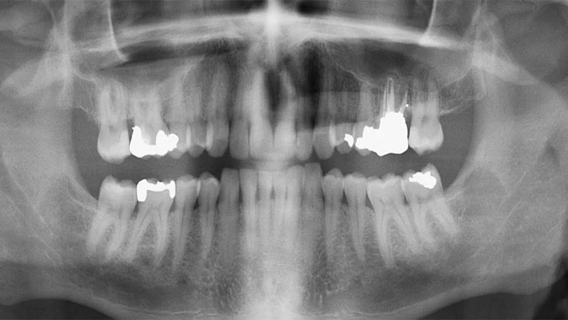 عکس opg دندان