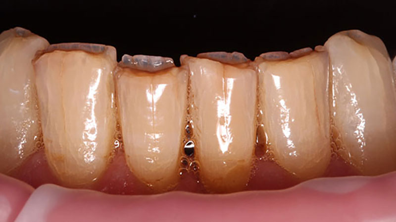 میزان تراش دندان برای لمینت دندان با توجه به ساختار دندان و ضخامت مینا