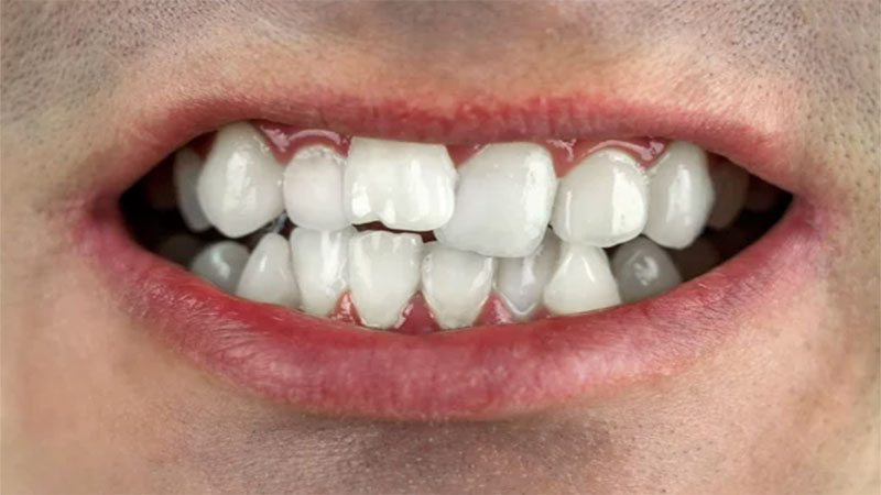 مشکلات بایت دندان