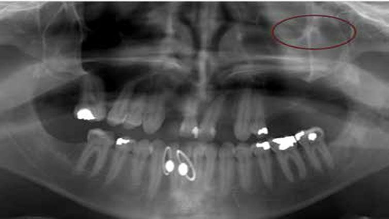 تشخیص مشکلات سینوسی با عکس opg دندان