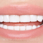 میزان تراش دندان برای لمینت دندان