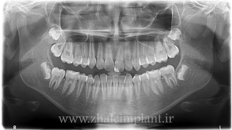 عکس opg دندان