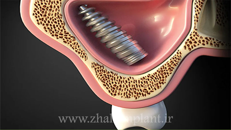 مفهوم افتادن ایمپلنت داخل سینوس