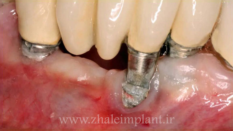 علائم لق شدن ایمپلنت دندان