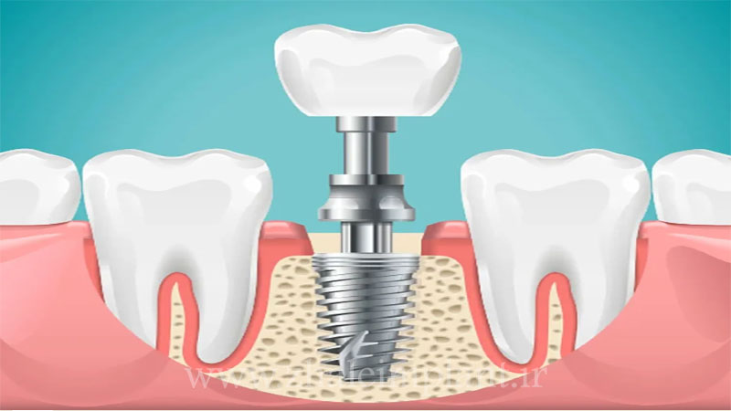 ایمپلنت دندان چیست؟