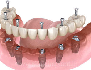 برای هر فک چند ایمپلنت لازم است؟