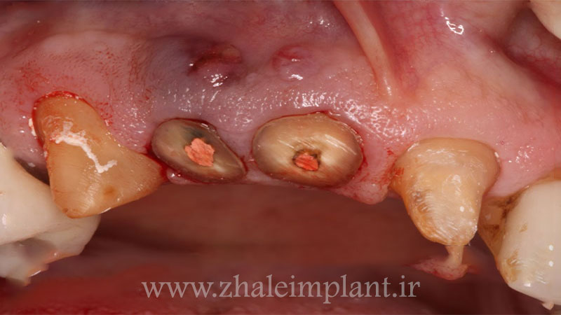 علل عفونت ایمپلنت دندان