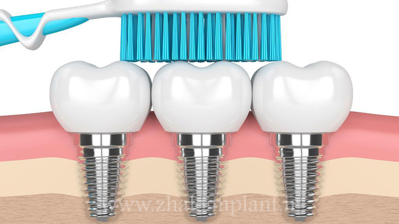 مسواک زدن منظم برای جلوگیری از عفونت ایمپلنت دندان