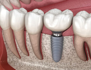 ایمپلنت دندان چقدر طول می کشد