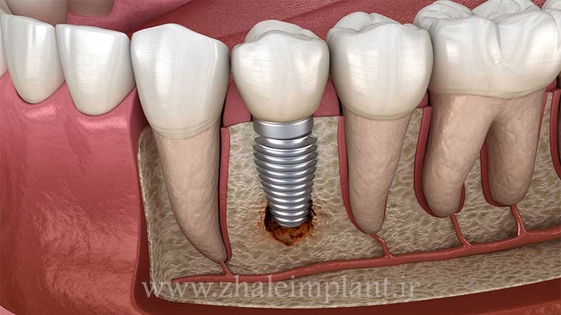 عدم پیوند موفق ایمپلنت با استخوان فک
