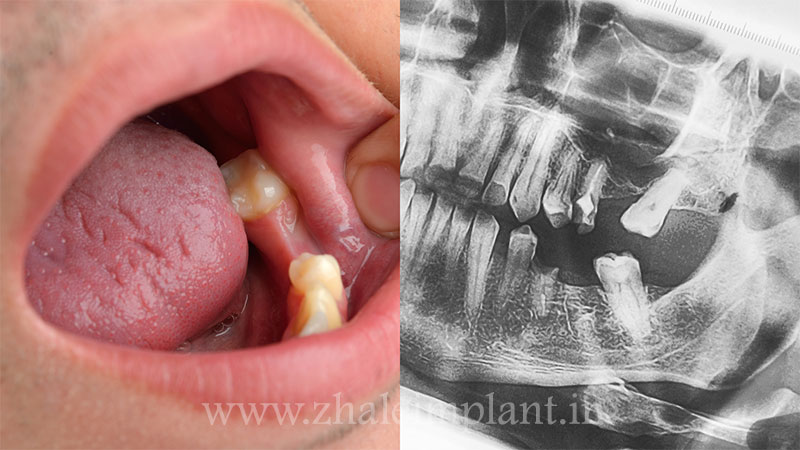 شرایط و محدودیت های مربوط به ایمپلنت دندان