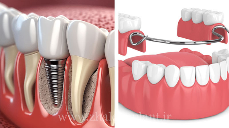 ایمپلنت یا دندان مصنوعی
