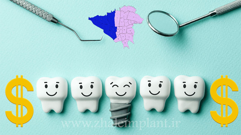 قیمت ایمپلنت در غرب تهران