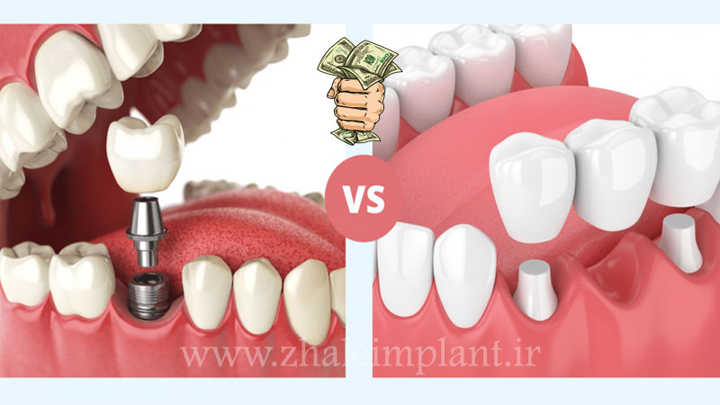 تفاوت قیمت کاشت دندان بدون ایمپلنت با ایمپلنت دندان