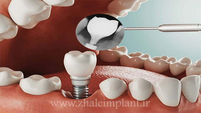 شکستن پیچ ایمپلنت دندان