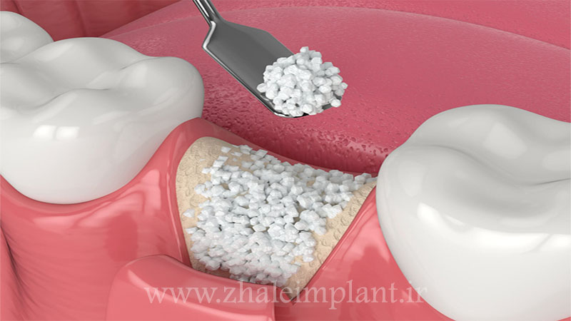 پودر استخوان در درمان ایمپلنت