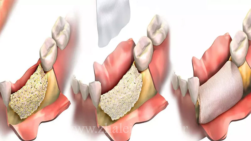 پودر استخوان چیست و چگونه در درمان ایمپلنت دندان کاربرد دارد؟