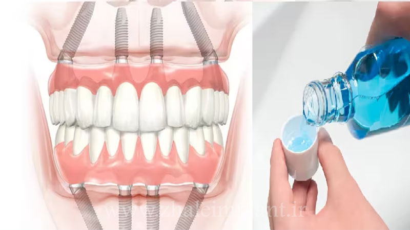بهترین دهانشویه برای ایمپلنت