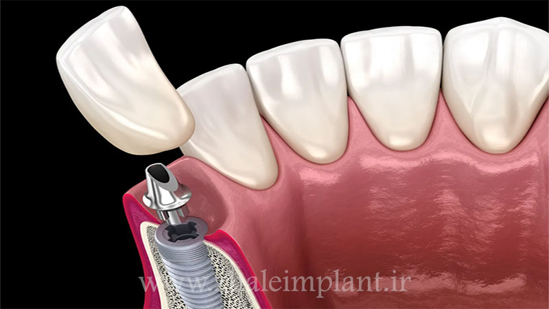 مراحل انجام ایمپلنت دندان در بیماران دارای نقص های مادرزادی